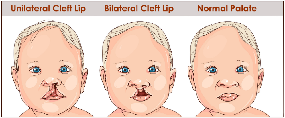Cleft Palate - Speech Therapy