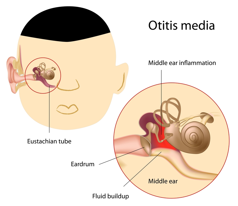 Otitis Media and Speech